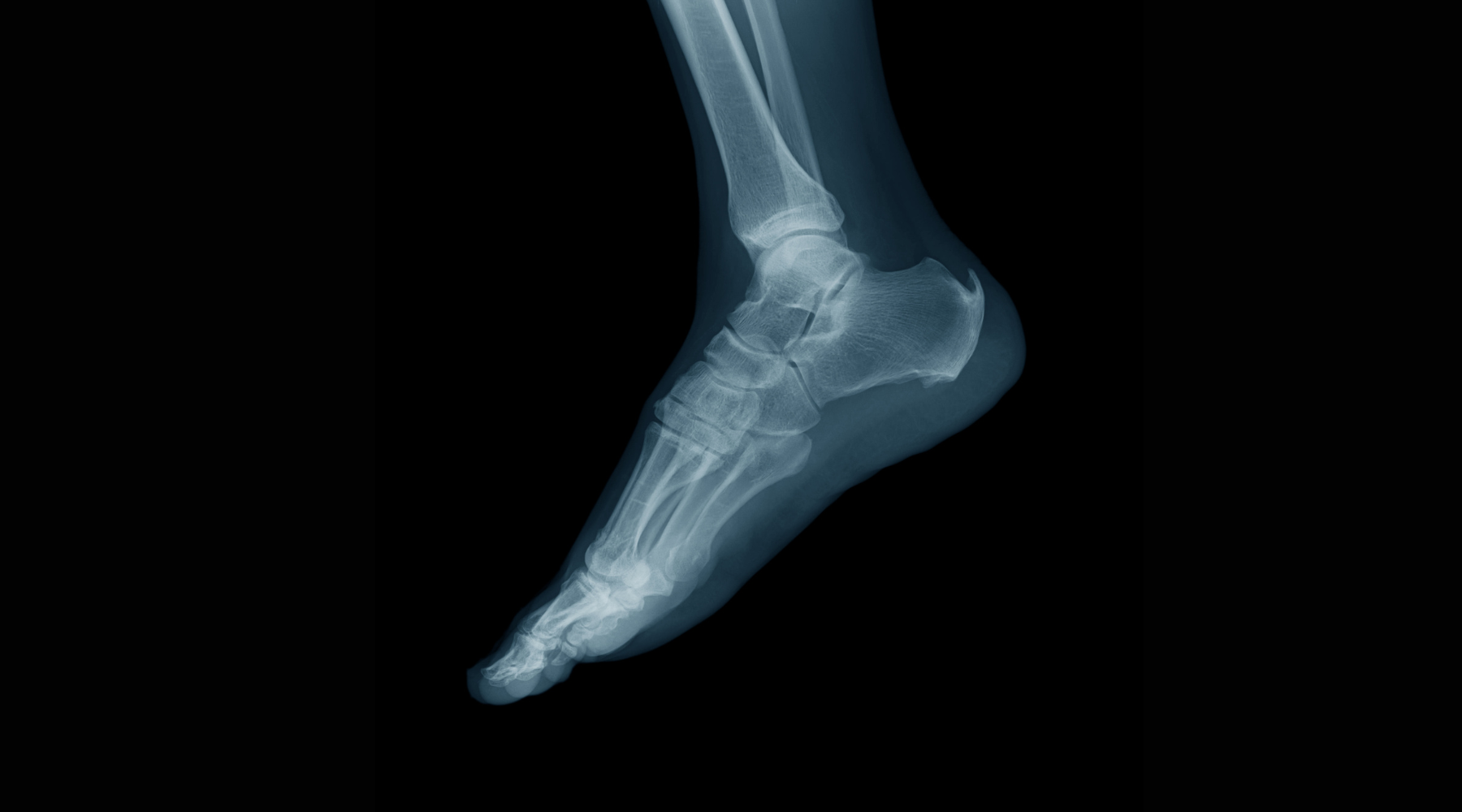 Bodywork: Getting to the bottom of Achilles heel spurs