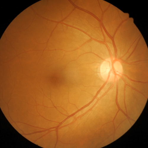 ETS Factors as Therapeutic Targets in Neovascular Eye Disease