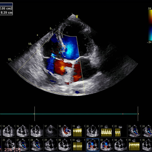 Thiol-reactive Compounds Attenuate Aortic Stenosis