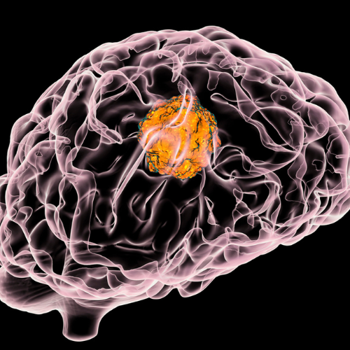 Monoclonal Antibody Therapy for Glioblastoma
