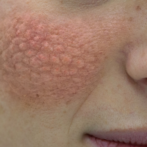 Biomarkers to Assess Heterogeneity of Treatment Response in Lupus Patients