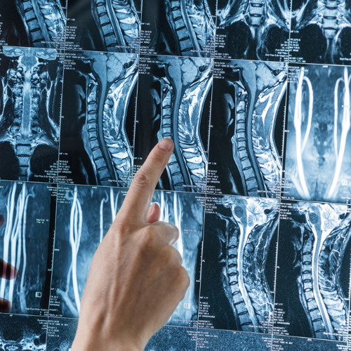 Treatment for a Rare Genetic Skeletal Dysplasia